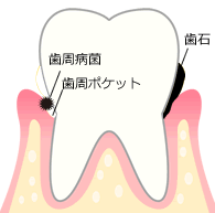 歯周病の原因