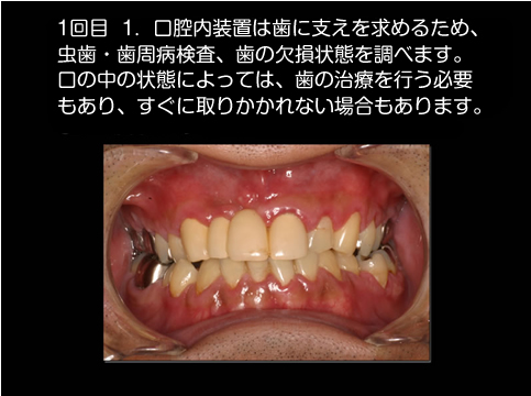 当院における無呼吸治療の進め方②