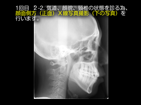 当院における無呼吸治療の進め方④